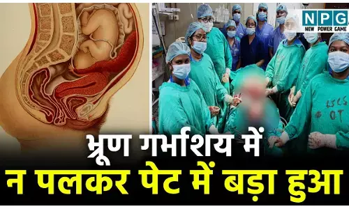 Chhattisgarh Hospital News: भ्रूण गर्भाशय में न पलकर पेट में बड़ा हुआ, आंबेडकर अस्पताल के डॉक्टरों ने किया कमाल, इमरर्जेंसी एंजियोप्लास्टी से जच्चा-बच्चा दोनों को बचा लिया...