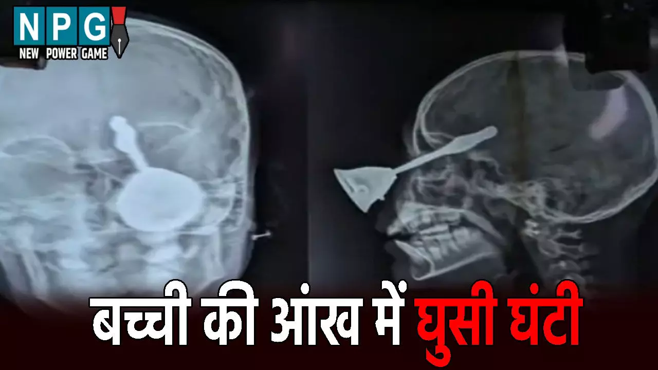 Bilaspur News: बच्ची की आंख में घुसी घंटी: खेलने के दौरान हादसा, गंभीर हालत में इलाज जारी