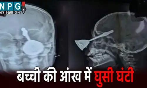 Bilaspur News: बच्ची की आंख में घुसी घंटी: खेलने के दौरान हादसा, गंभीर हालत में इलाज जारी