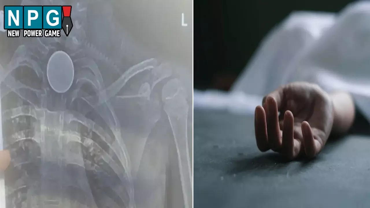 Korba News: मासूम के सीने में फंसा सिक्का: जिला अस्पताल ने कर दिया रेफर, बीच रास्ते में हुई मौत, परिजनों ने लगाया लापरवाही का आरोप