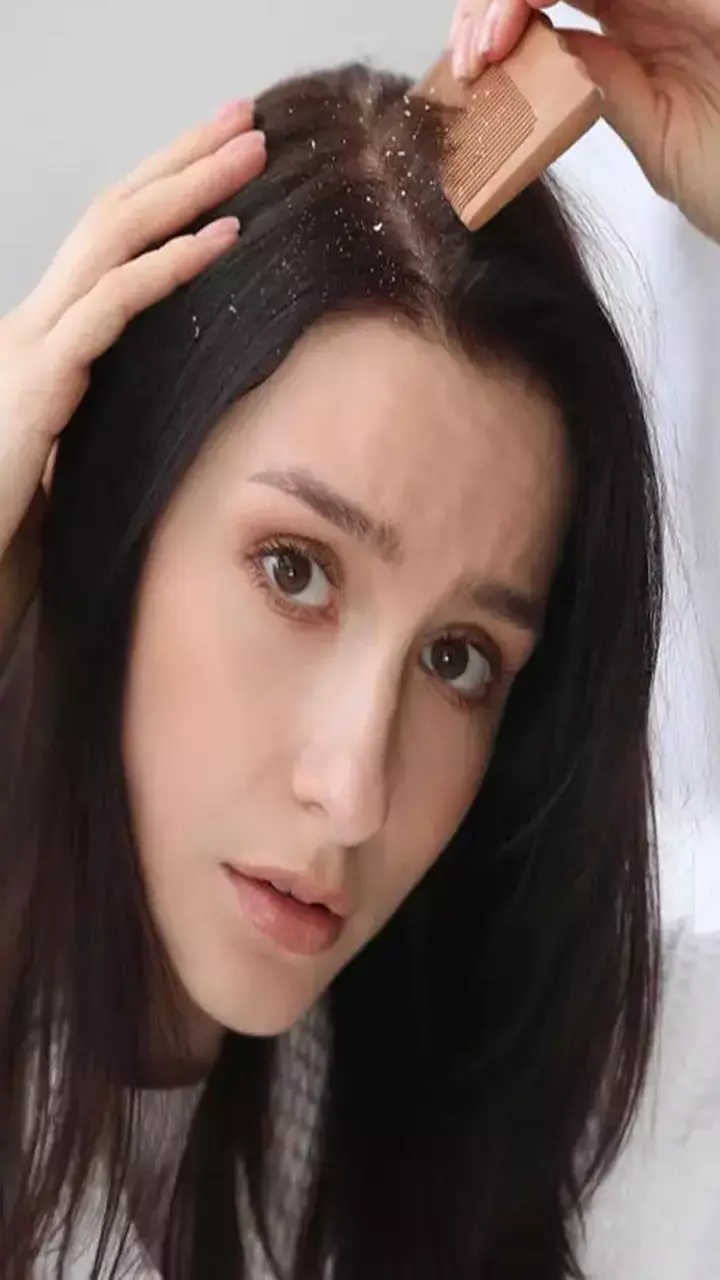 Dahi Se Dandruff Kaise Hataye: डैंड्रफ हटाने के लिए दही से हेयर मास्क कैसे बनाएं?