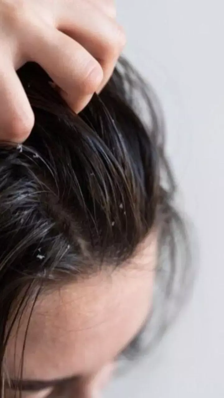 Bar Bar Dandruff Hone Ka Karan: बालों में बार बार डैंड्रफ क्यों होता है?