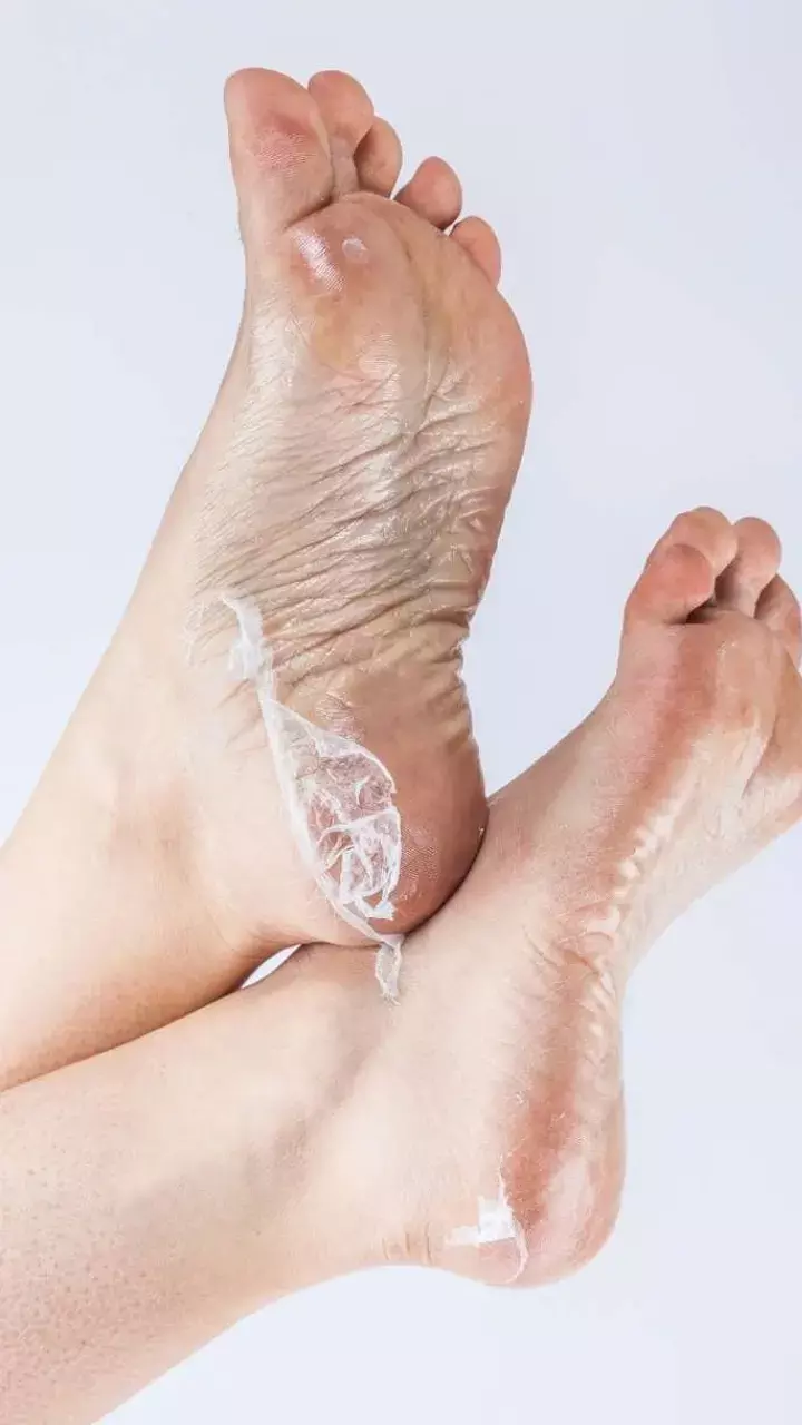 Sardiyon Me Adiya Kyu Fatti Hai: सर्दियों में क्यों फटती हैं एड़ियां, जानें कारण और उपाय, तुरंत मिलेगी राहत....