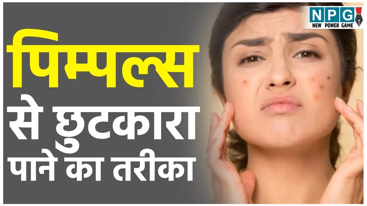 Pimples Se Kaise Chutkara Payain: मिल गया पिम्पल्स से छुटकारा पाने का तरीका,आप भी जान लीजिए Pimples Se Kaise Chutkara Payain: मिल गया पिम्पल्स से छुटकारा पाने का तरीका,आप भी जान लीजिए