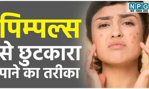 Pimples Se Kaise Chutkara Payain: मिल गया पिम्पल्स से छुटकारा पाने का तरीका,आप भी जान लीजिए
