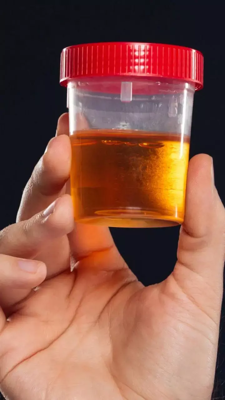 Peshab se badbu Aane Ke Karan: पेशाब से गन्दी बदबू क्यों आती है?