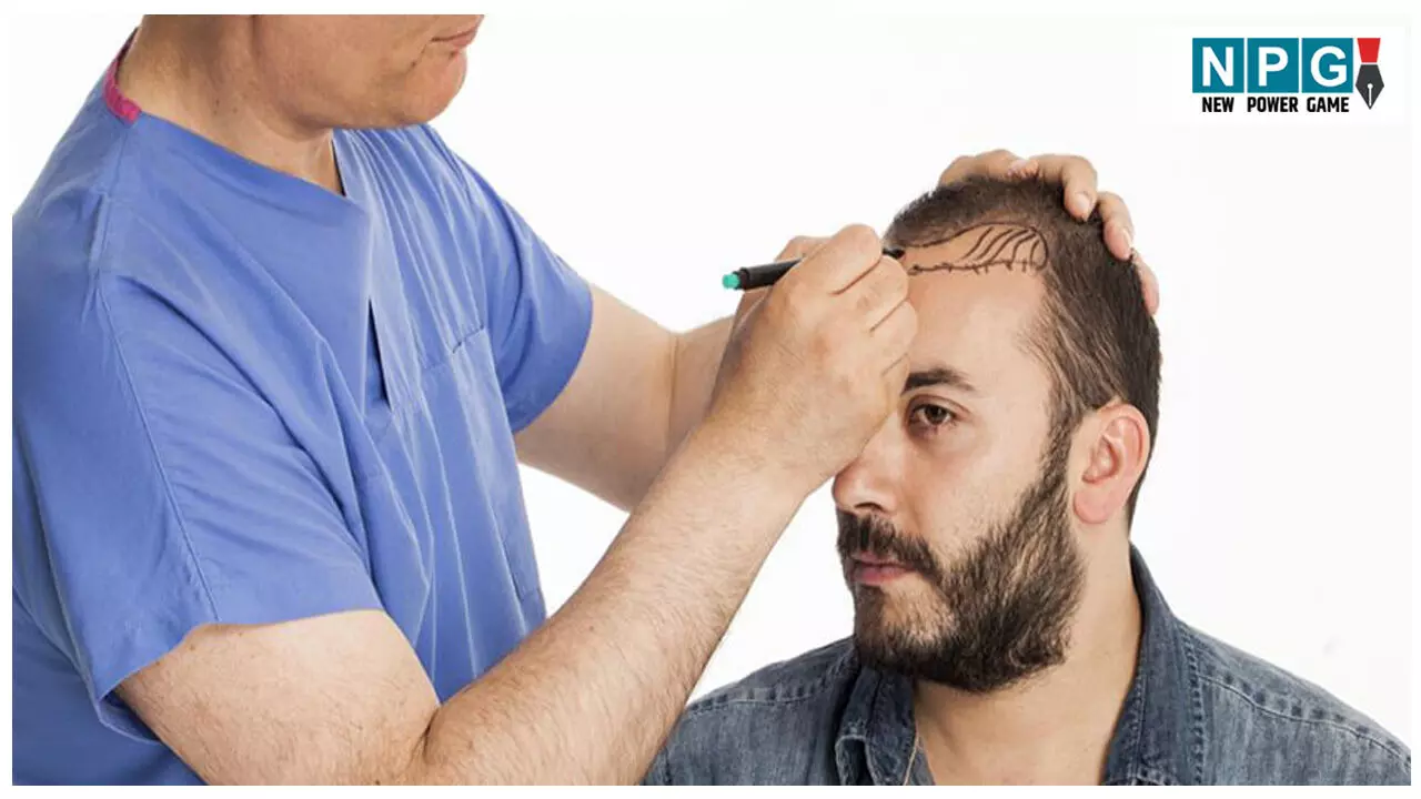 Hair transplant se Jude kuchh Myth: क्या सच में हेयर ट्रांसप्लांट कराने पर नकली बाल लगा दिया जाता है? जानिए इसको लेकर फैले मिथक की पूरी सच्चाई! Hair transplant se Jude kuchh Myth: क्या सच में हेयर ट्रांसप्लांट कराने पर नकली बाल लगा दिया जाता है? जानिए इसको लेकर फैले मिथक की पूरी सच्चाई!