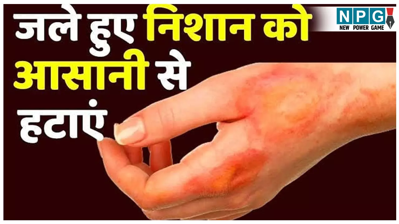 How To Get Rid Of Burn Marks At Home: स्किन पर पड़ गया है जलने का निशान, तुरंत आज़माइये ये घरेलू नुस्खे How To Get Rid Of Burn Marks At Home: स्किन पर पड़ गया है जलने का निशान, तुरंत आज़माइये ये घरेलू नुस्खे
