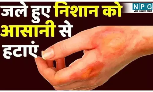 How To Get Rid Of Burn  Marks At Home: स्किन पर पड़ गया है जलने का निशान, तुरंत आज़माइये ये घरेलू नुस्खे