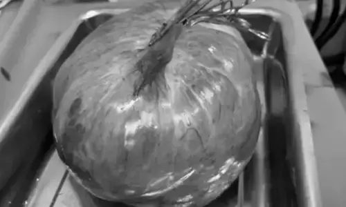 पेट में 15.5 किलो का ट्यूमर, महिला चल तक नहीं पाती थी, डॉक्टरों ने किया ऑपरेशन