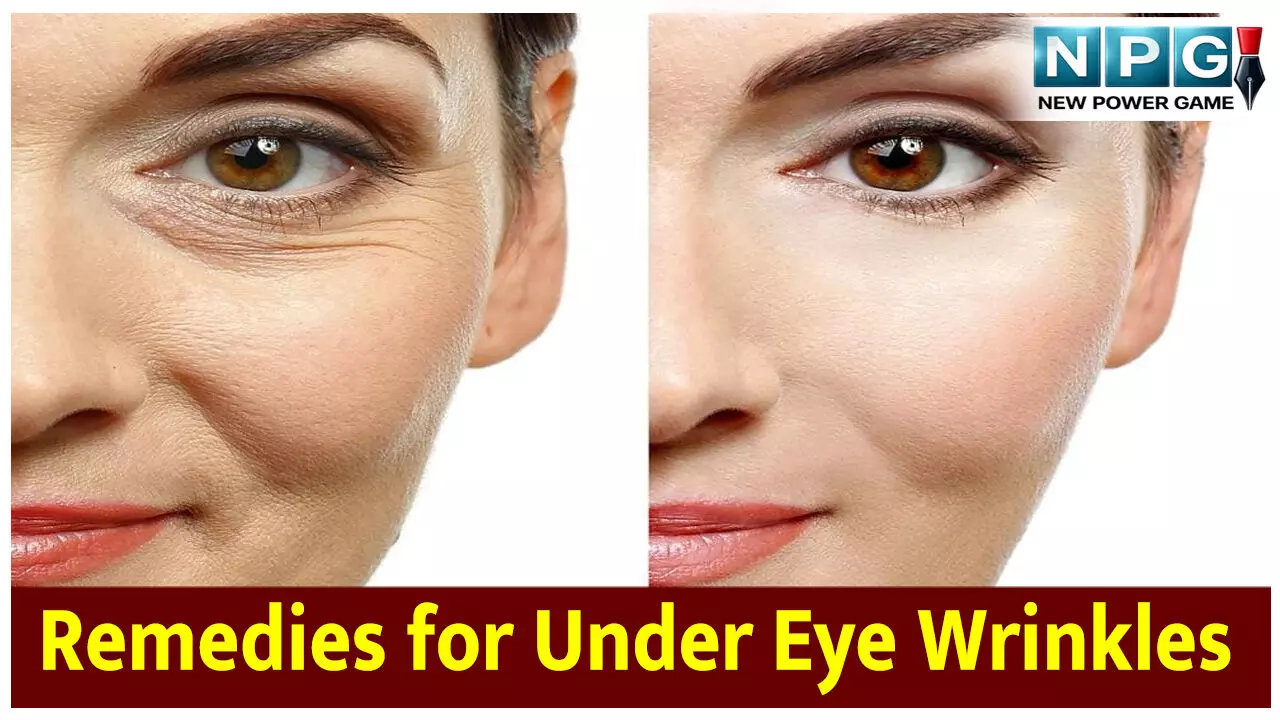 Home Remedies for Under Eye Wrinkles: ​आंखों के नीचे की झुर्रियां और Crows Feet से छुटकारा पाने के आसान घरेलू उपाय