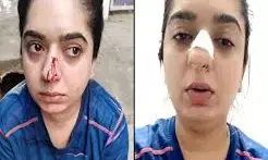 ऑर्डर लेने से इनकार करने पर Zomato Delivery Boy ने लड़की को मारा मुक्का, तोड़ी लड़की की नाक… वीडियो शेयर कर सुनाई आपबीती